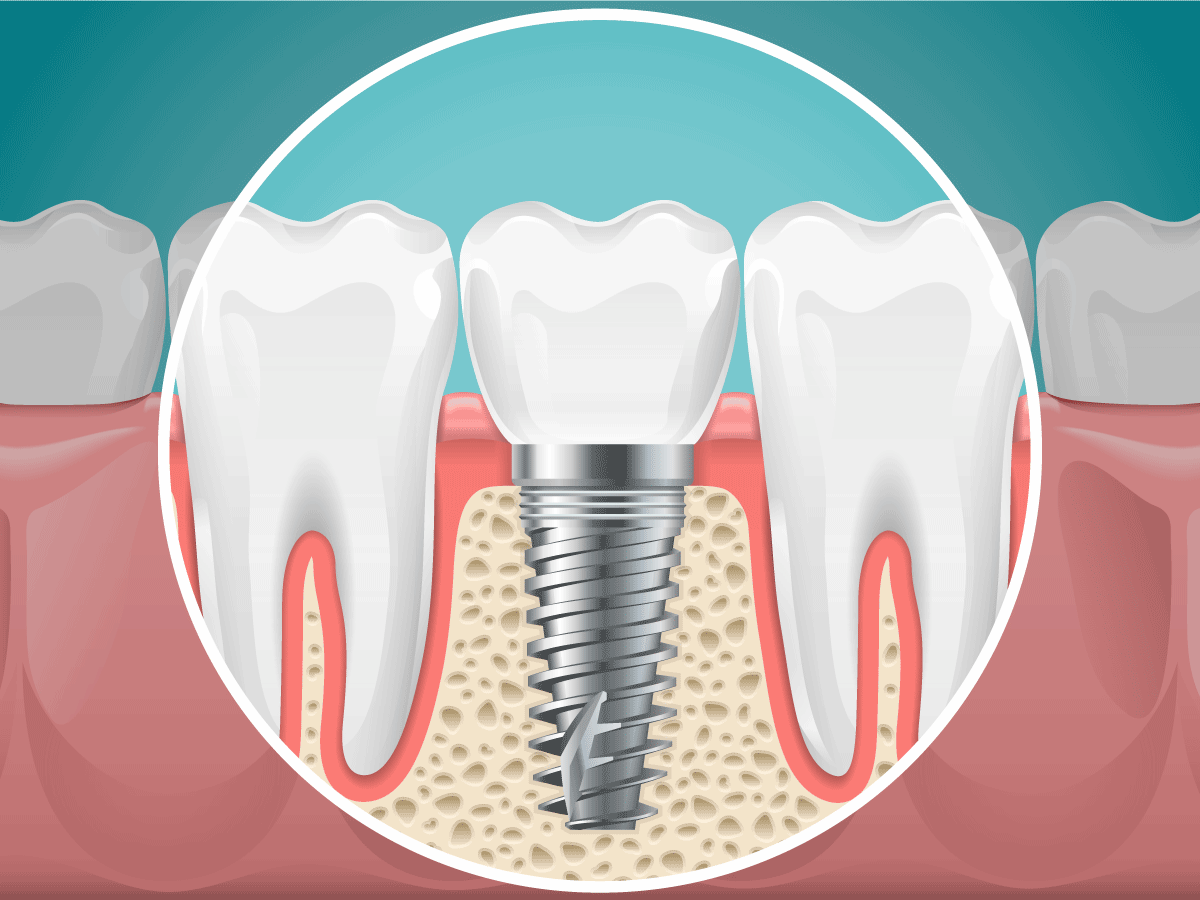 Dental Implant