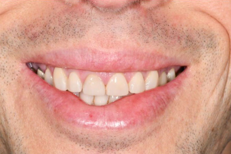 Dental Composite Bonding after