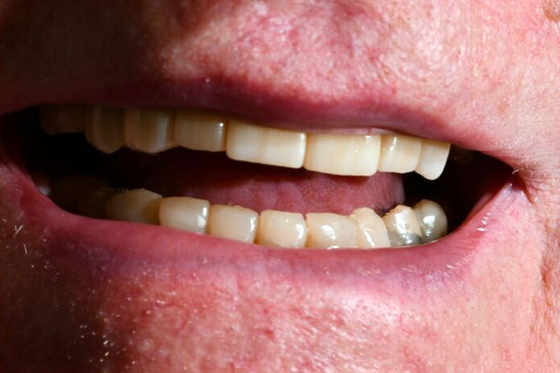 Dental Composite Bonding after
