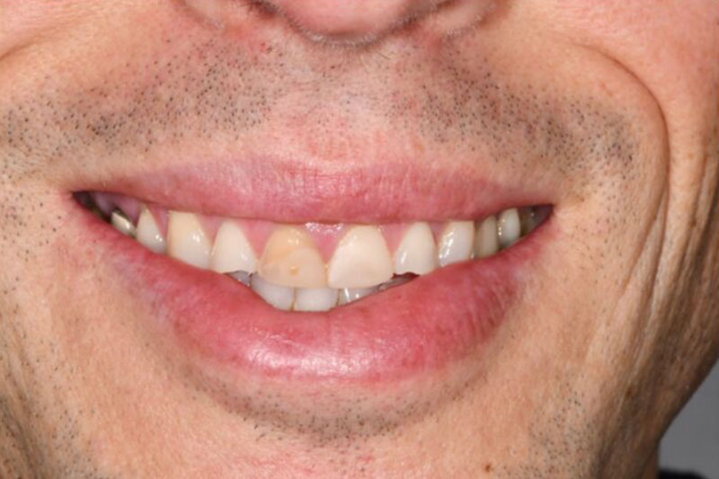 Dental Composite Bonding before