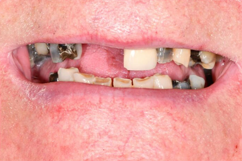 Dental Composite Bonding before